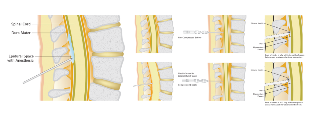 epidural,side,steps,insertion